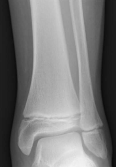 Tibia and Fibula Growth Plates