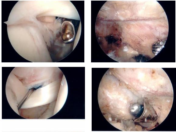 Images taken during shoulder surgery