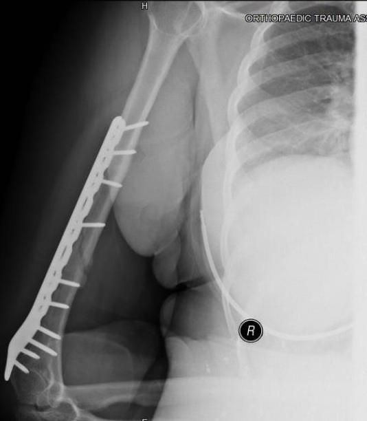 Plate and screws in humerus (upper arm bone)