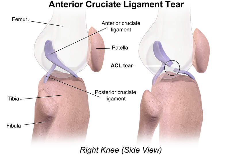 ACL tear