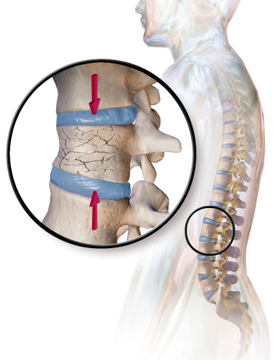 Spinal Compression Fractures in Vertebrae