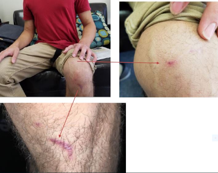 current scars to leg after car accident