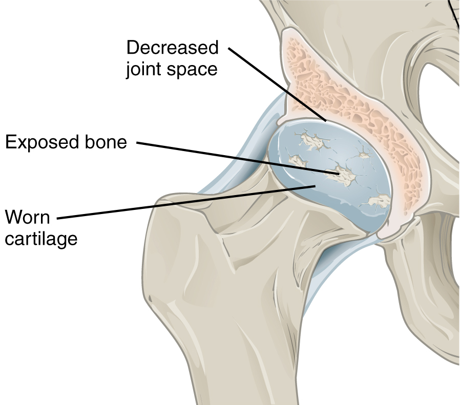 Hip joint with osteoarthritis
