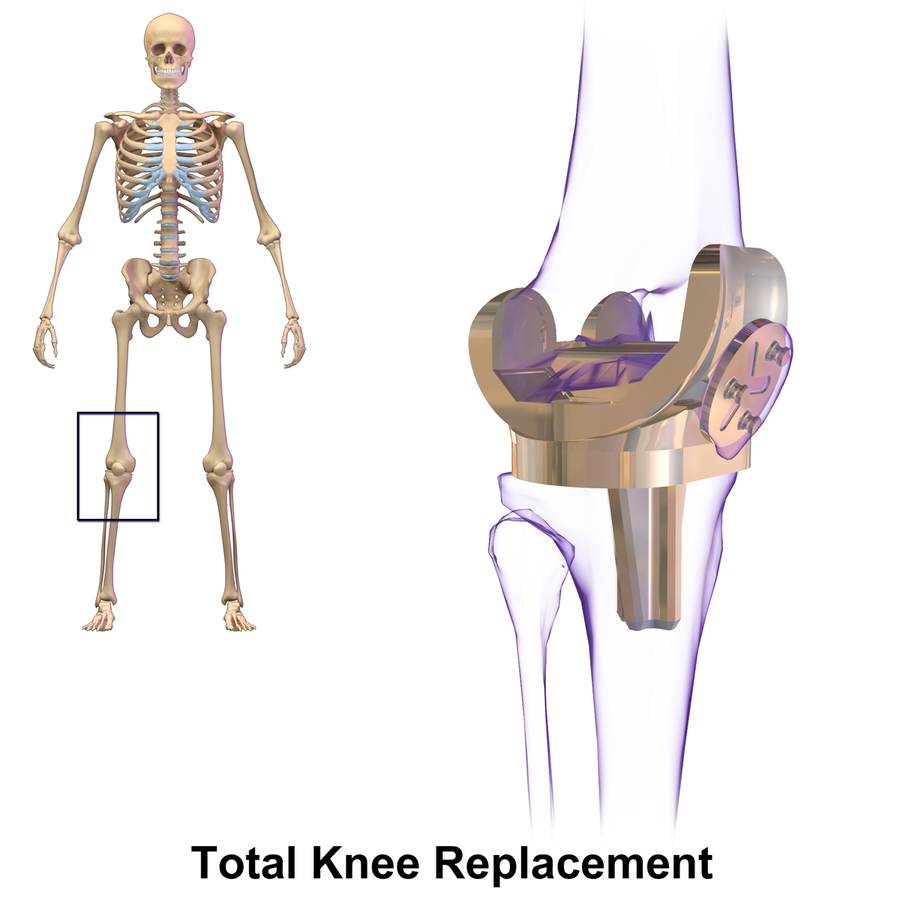 Knee Replacement