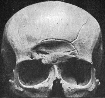 Depressed skull fracture