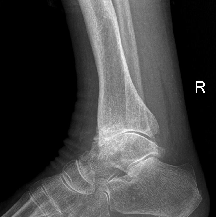 Secondary osteoarthritis (due to an old injury with fracture) of the ankle in a woman of 82 years old