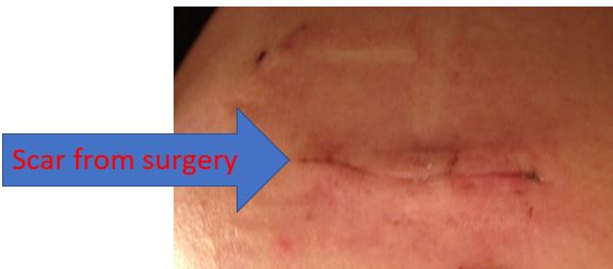 incision scar after rotator cuff surgery