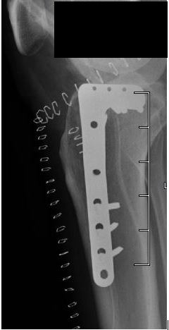 tibial plateau fracture with screws and plate