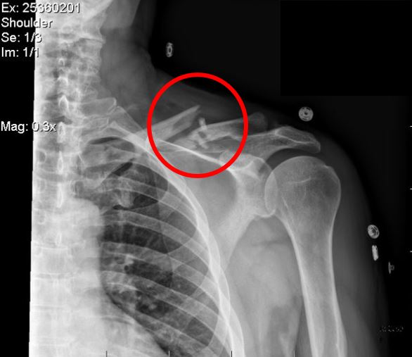 X-ray of motorcyclist's comminuted clavicle fracture