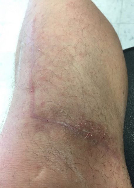 scar and rash 9 months after tibial plateau fracture surgery