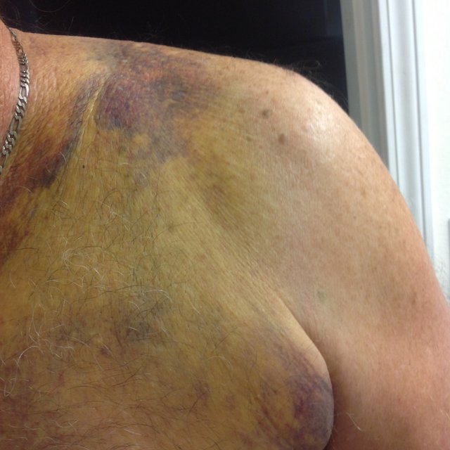 bruising to his collarbone area