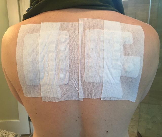 allergy patch test on back