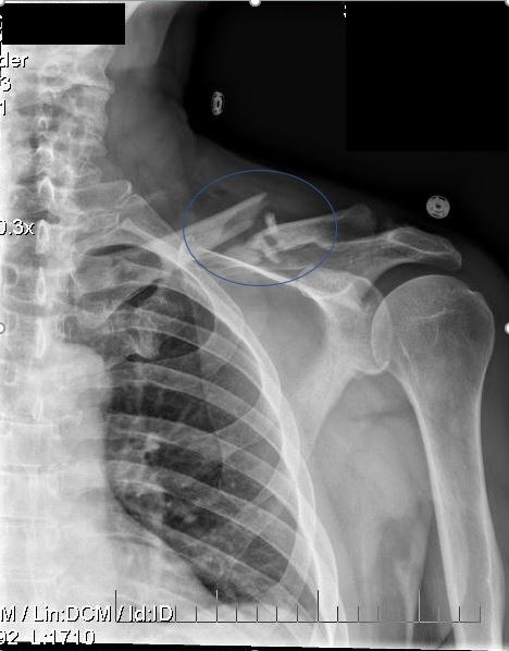 Collarbone clavicle (communited) fracture x-ray