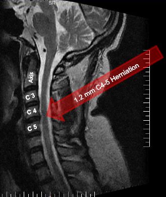 1.2mm C4-C5 disc herniation