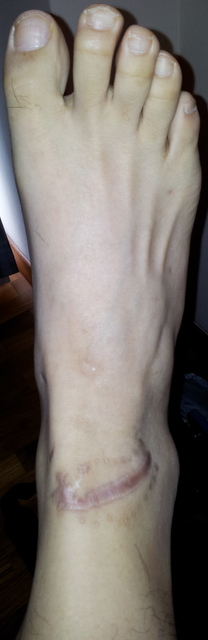 scar on ankle area from shattered non-tempered glass