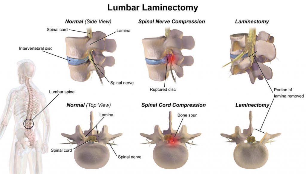 Lumbar Laminectomy 