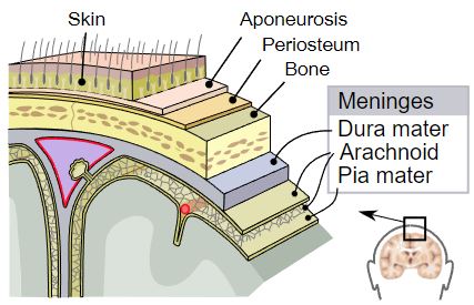 Compound skull fracture