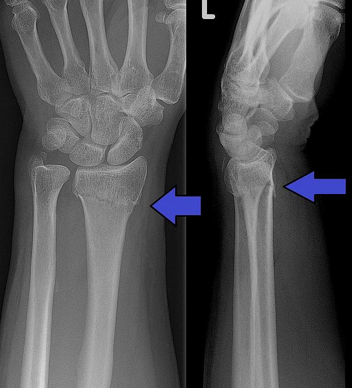 Distal radius fracture (Broken wrist) A Colles fracture as seen on X-ray. It is a type of distal radius fracture.