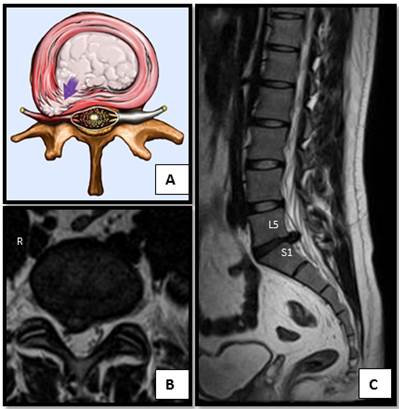 Nucleus herniating through tear in anulus (with MRI)