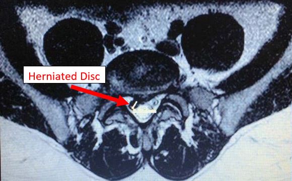 L5-S1 herniated disc top down view