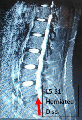 Arrow pointing at herniated disc at L5-S1
