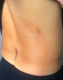 Incision to lower back made during L5-S1 laminotomy surgery
