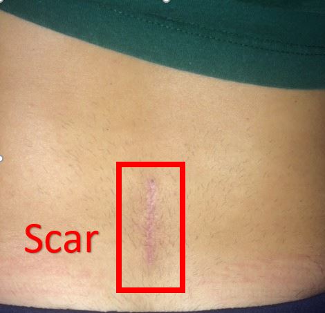 scar after L5-S1 hemilaminotomy and discectomy surgery