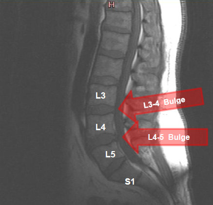 L3-L4 Bulge, L4-L5 Bulging disc