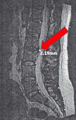 2.19 mm herniated disc in lower back (L2-L3)