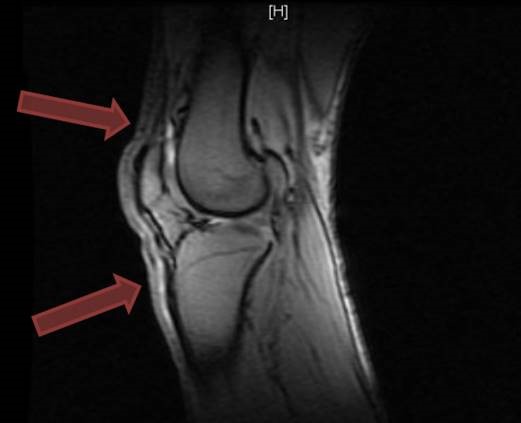 knee MRI