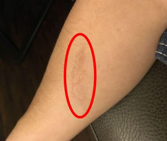 red circle around scar on forearm