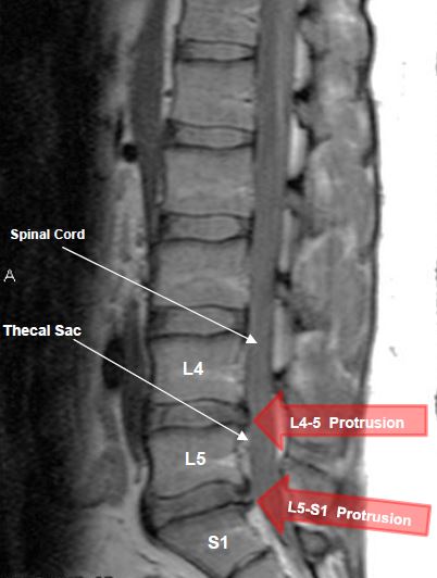 L4-L5 and L5-S1 disc protrusions