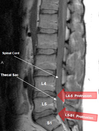Протрузия диска на уровне l5 s1