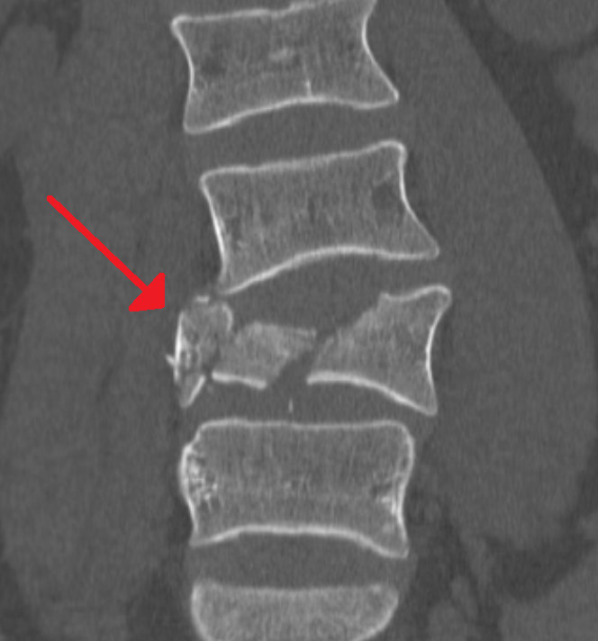 burst fracture of L4 on CT scan