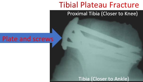 tibial plateau fracture with plate and screws