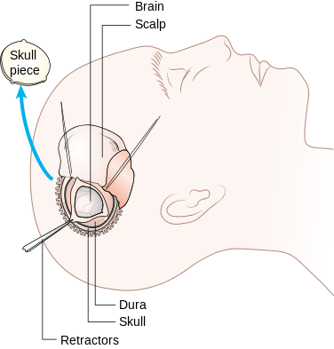 376px-Diagram_showing_a_craniotomy_CRUK_063.svg