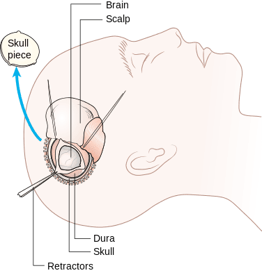 376px-Diagram_showing_a_craniotomy_CRUK_063.svg