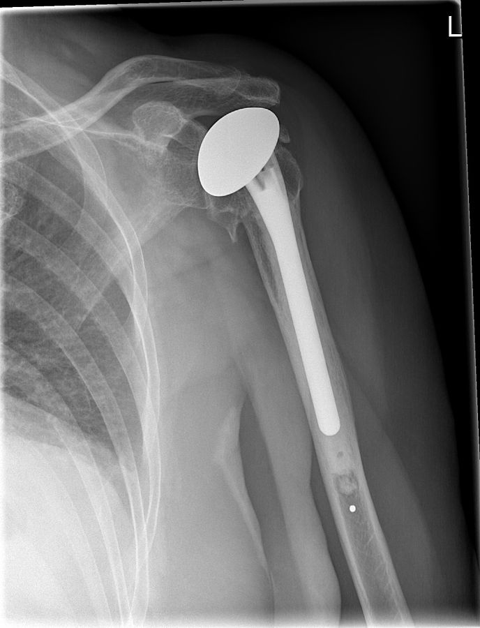 Shoulder replacement (xray of Shoulder prothesis)
