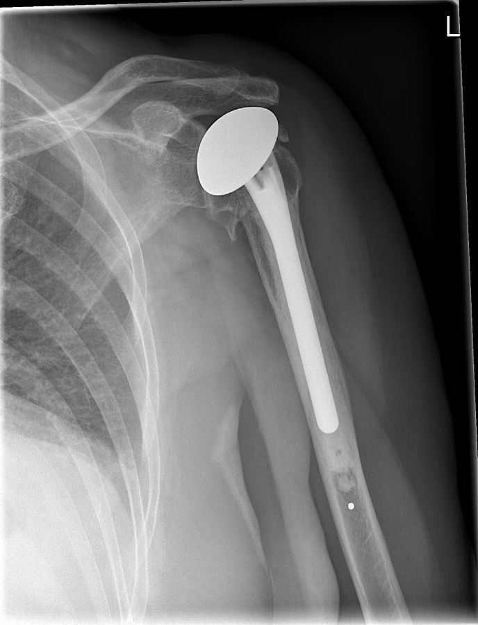 Shoulder replacement (xray of Shoulder prothesis)