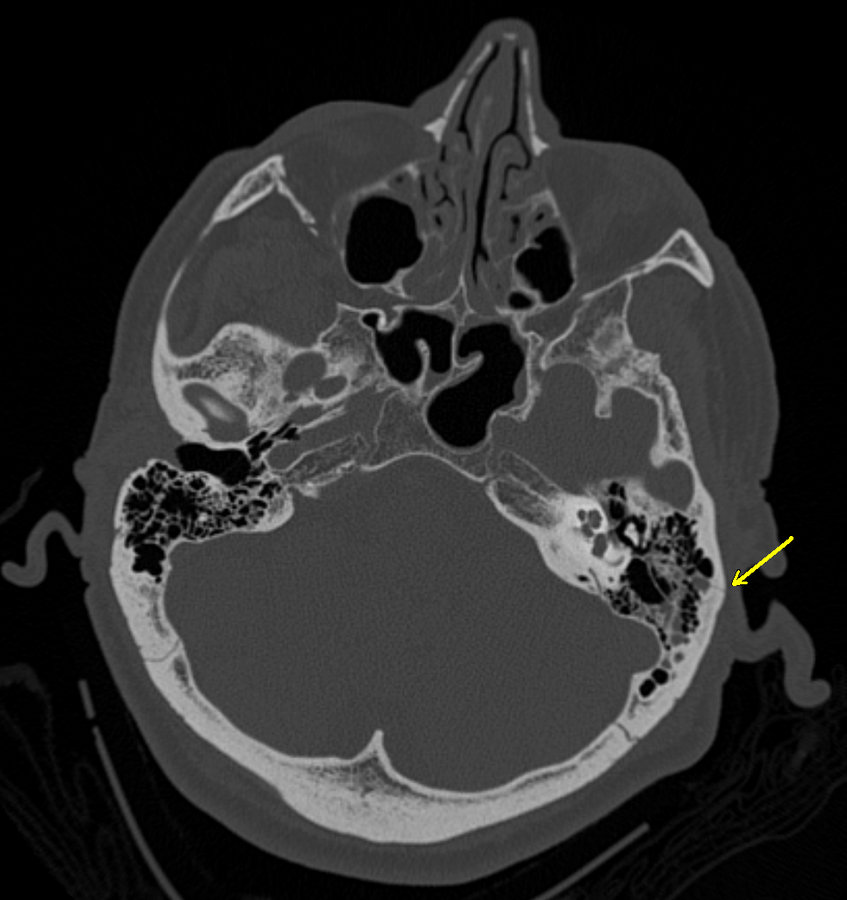 Basilar skull fracture