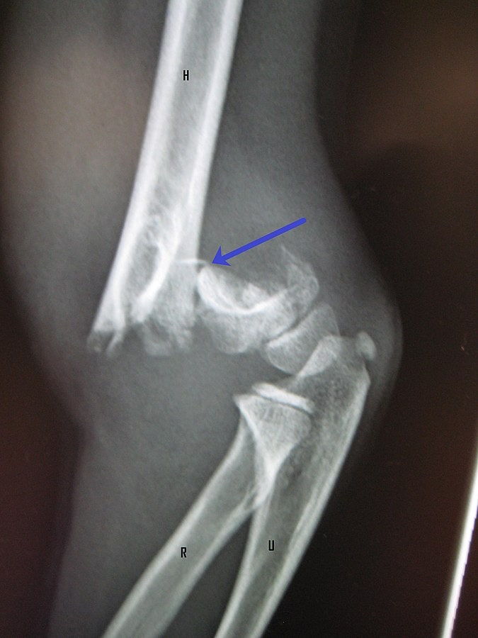 Supracondylar humerus fracture