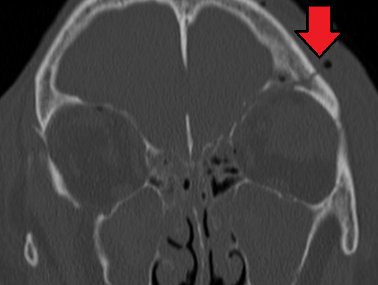 A basilar skull fracture as seen on CT