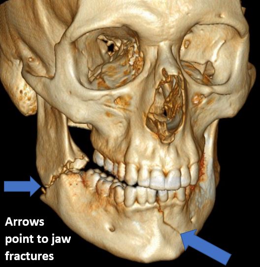 jaw fractures 