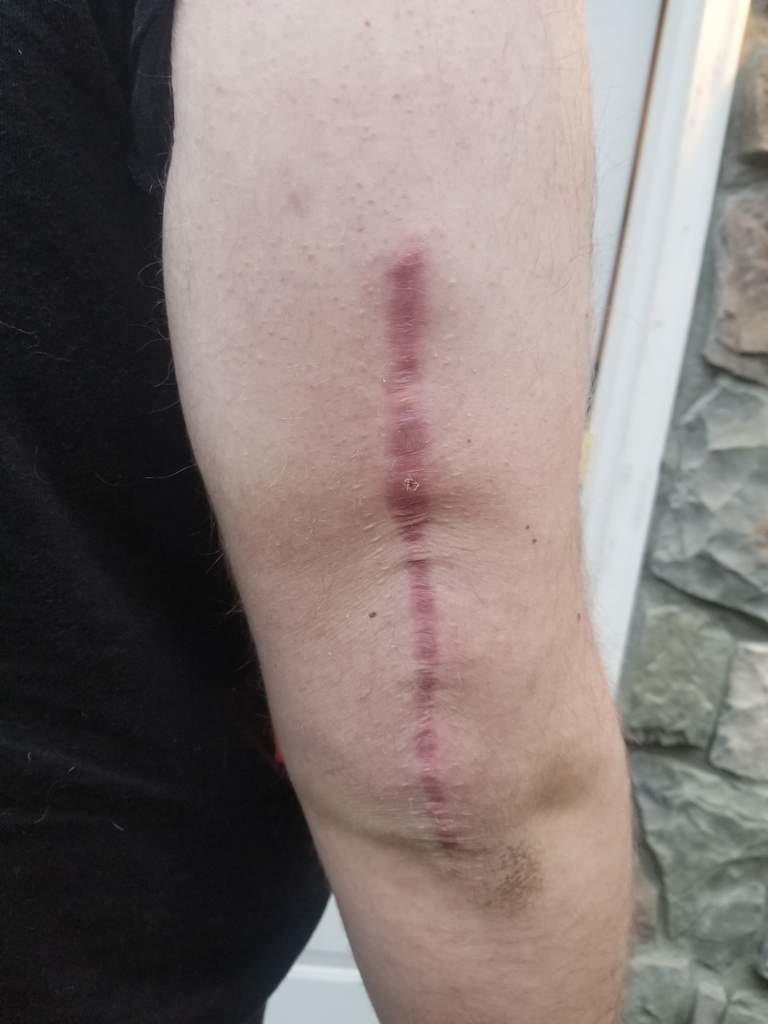 scar on back of upper arm after surgery on humerus