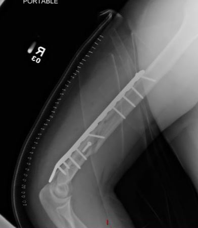 x-ray showing plate and screws in upper arm bone (humerus) on young man