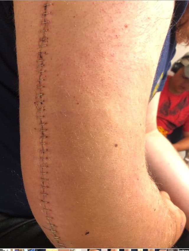 staples in upper arm after ORIF surgery to fix humerus 