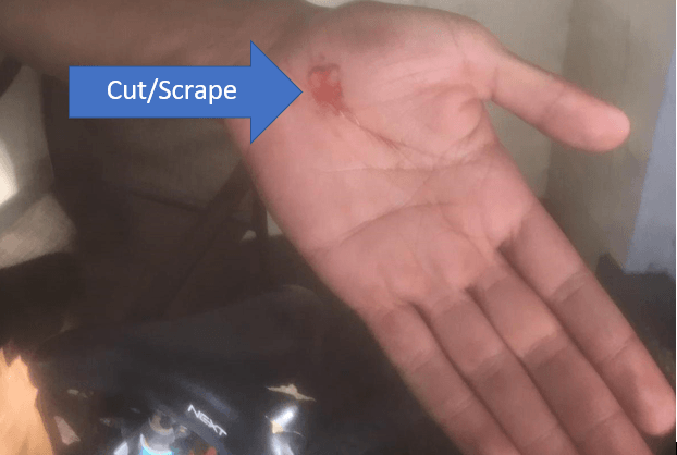 arrow pointing to cut (scrape) on palm of hand  