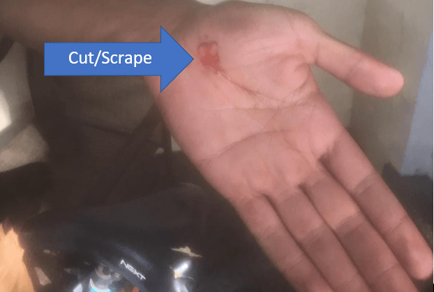 arrow pointing to cut (scrape) on palm of hand