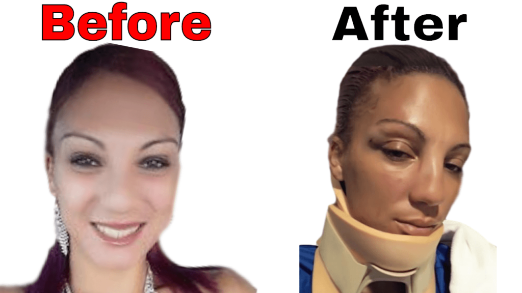 Photo before car accident shows pretty woman. Photo after shows her bruised face and she's in a neck brace