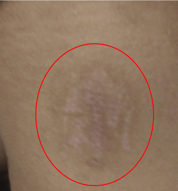 discolored skin on a person's thigh 